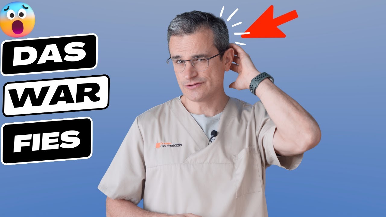 Gürtelrose, Herpes zoster, Symptome, Behandeln, #zoster #herpeszoster ...