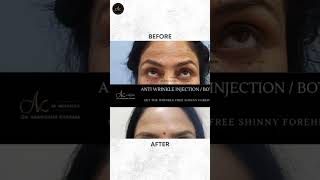 Botox: Smooth Wrinkles, Refresh Your Look #shorts #botox #beauty