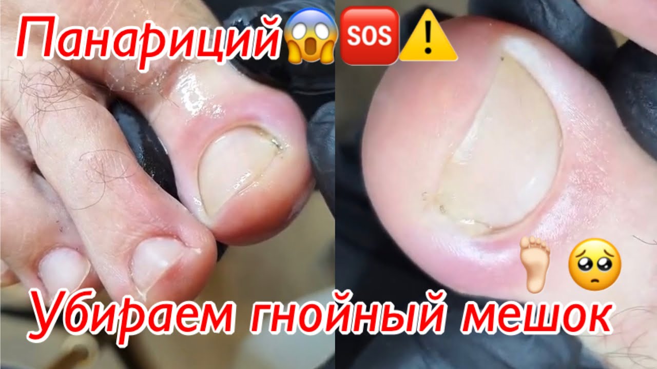 Панариций😱🆘⚠️🦶🏻 • Убираем гнойный мешок🦶🏻🥺
