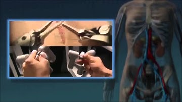 CMHS - da Vinci Partial Nephrectomy