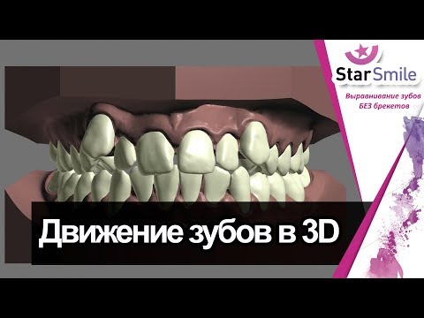 Виртуальный сетап (моделирование улыбки для элайнеров)★Star Smile★