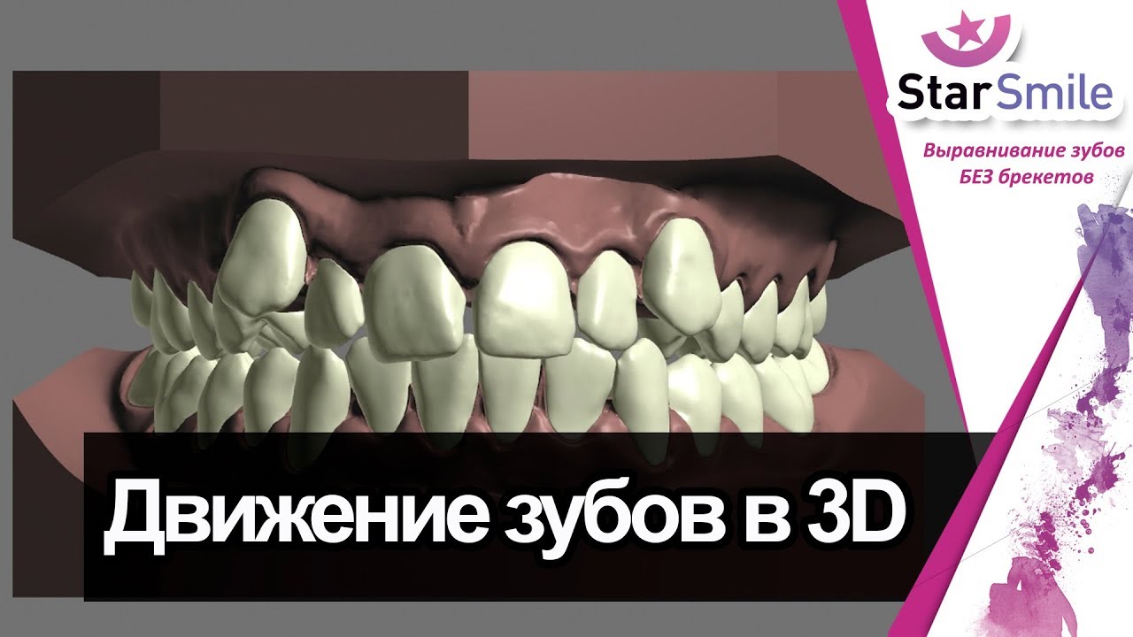 Элайнеры Что Это Такое Фото Цена Элайнеры Что Это Такое Фото Цена
