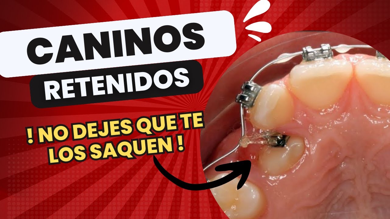 "¡NO DEJES QUE TE SAQUEN😲🦷 LOS CANINOS RETENIDOS! LO QUE NECESITAS SABER PARA SALVAR TU SONRISA"