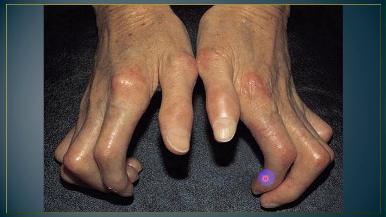 محاضرة علمية(المرحلة الخامسة  / مادة الباطنية /المفاصل/systemic sclerosis)