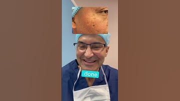 Thumbnail of CHICKEN POX SCARS - DR. TANVEER JANJUA - NEW JERSEY