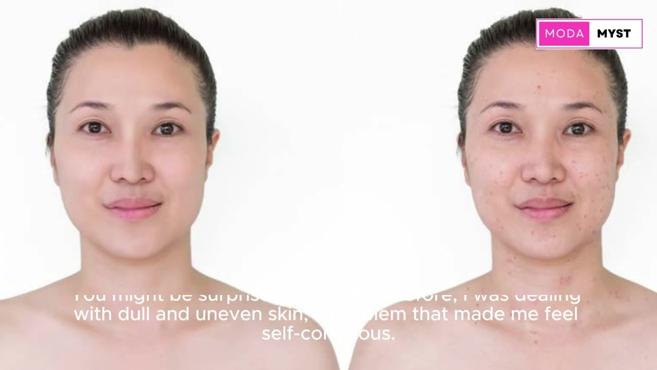 From Dull to Dazzling: My Skin Transformation Story || Modamyst ||