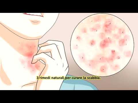 3 rimedi naturali per curare la scabbia