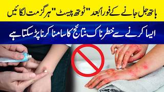 Never Apply Toothpaste on a Burn! It Could Make Things Worse - Burn First Aid