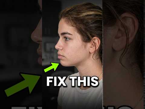 Video thumbnail: Rhinoplasty & Orthognathic Surgery (Jaw Dropping Transformation) · Dr. Derek Steinbacher