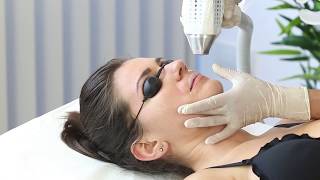 Eme - Epil Evo, Trattamento Con Laser A Diodo Su Labbra