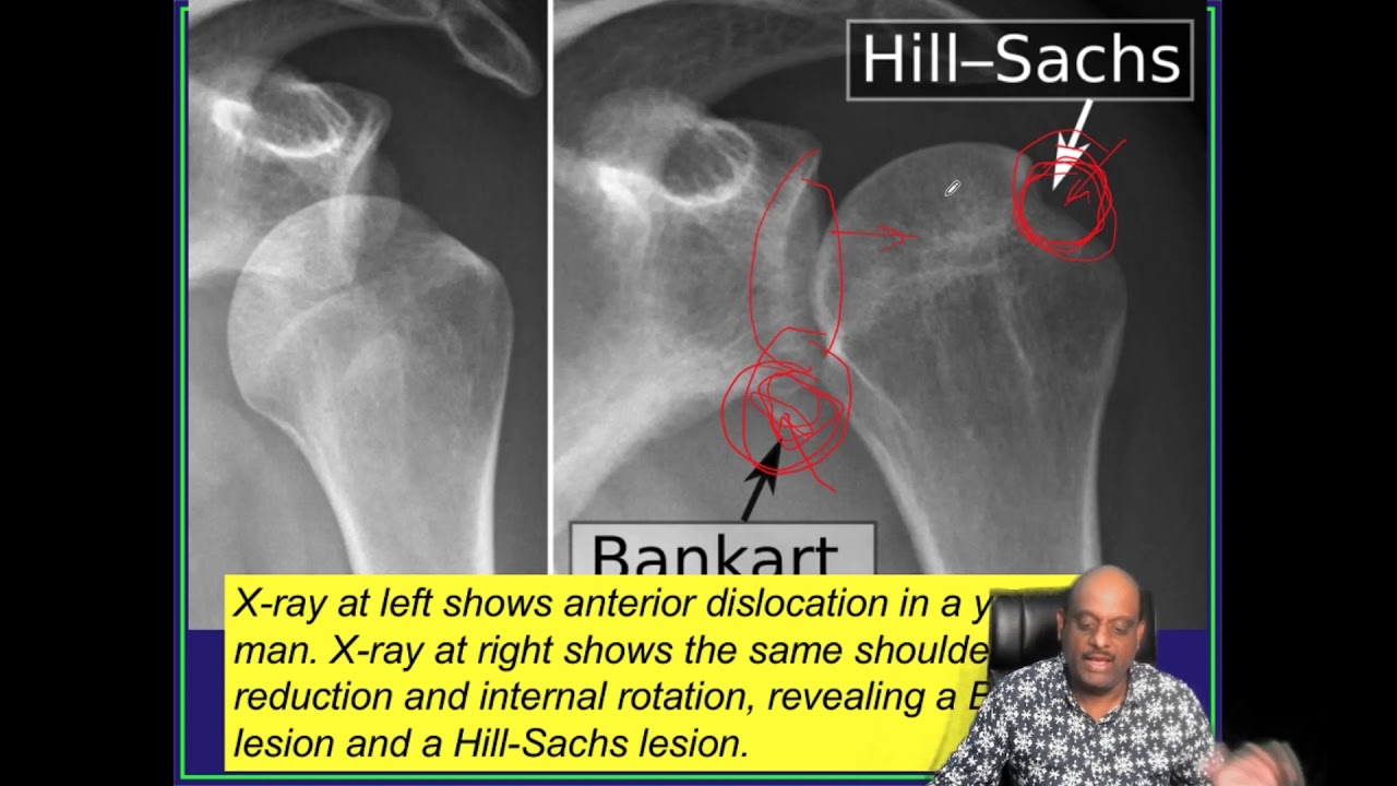 MBBS Final Year Shoulder Dislocation YouTube