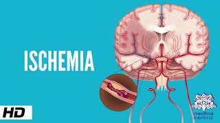 Ischemia, Causes, Signs and Symptoms, Diagnosis and Treatment.