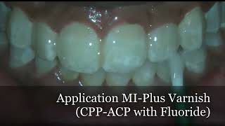 Treatment of Incipient Carious Lesion screenshot 4