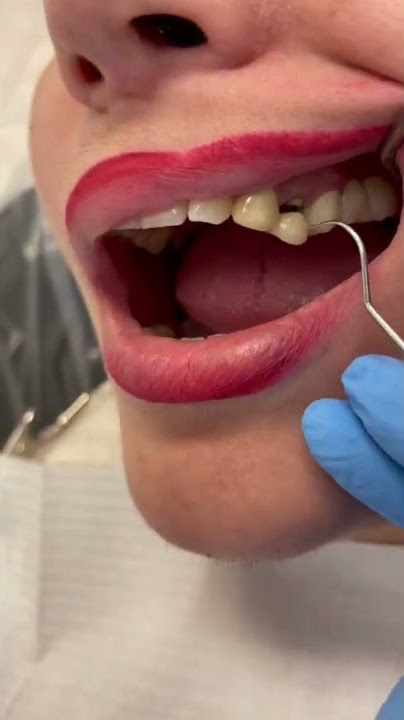 Broken crown #fyp #tiktok #video #viral #trending #dentist #desigamer #love ##smile #love #tooth