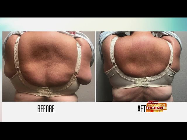 Bra Fat Be Gone: Destroy Excess Fat With Kybella: Rostami OPC
