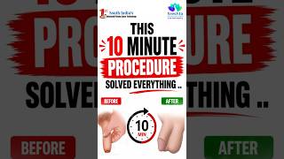 Phimosis Surgery in 10 Minutes || Advanced 3rd Gen Stapler Circumcision || Sreshta Hospitals