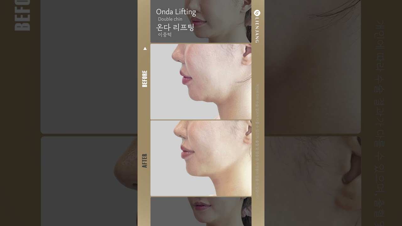 [Риенжанг гоо сайхны мэс заслын эмнэлэг] Онда лифтинг давхар эрүү