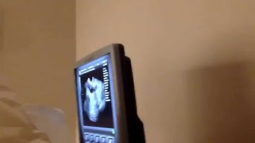 IVF : follow-up #2 Stim Day 7