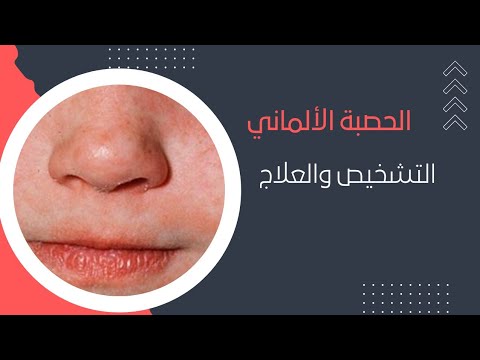علاج الحصبة الألمانية