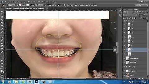 Thiết Kế Nụ Cười Kỹ Thuật Số – Giải Pháp Hoàn Hảo Cho Nụ Cười Tự Nhiên