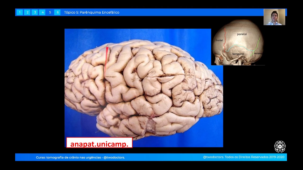 AULA GR TIS SOBRE ANATOMIA DO PAR NQUIMA ENCEF LICO NA TC PARTE 1 aula-gr-tis-sobre-anatomia-do-par-nquima-encef-lico-na-tc-parte-1