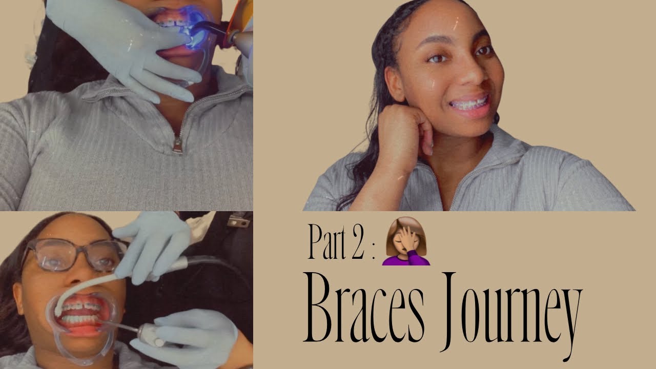 Vlog PART 2 Braces Journey ! YouTube