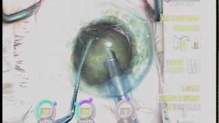 Cataract Surgery Phaco Chop By Uday Devgan Md Los Angeles