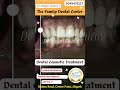 Clinical case @Dr  Major Gaurav @TheFamilyDentalCenterAligarh @bestdentistinaligarh