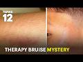 Bronx mom demands probe after child returns from therapy with bruises