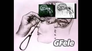 Lobotomy Sound Effect - Sparta Loophole Remix