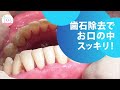 歯石除去で歯周病や口臭を予防‼︎ Prevent Periodontal Disease and Bad Breath Removing Tartar