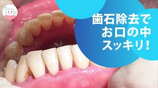 歯石除去で歯周病や口臭を予防‼︎ Prevent Periodontal Disease and Bad Breath Removing Tartar