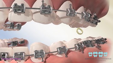Posterior Crossbite Elastics