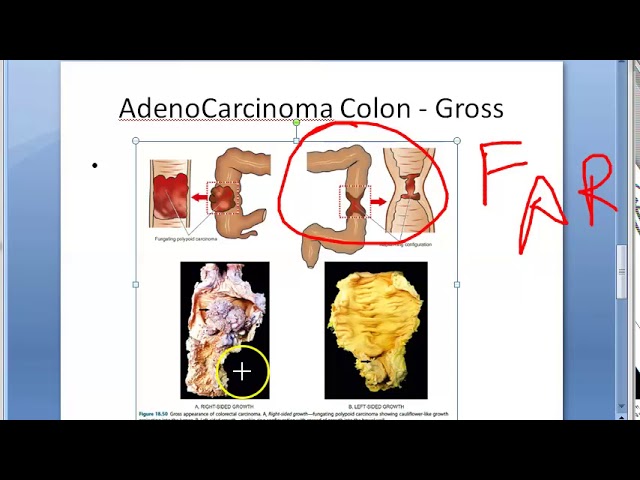 Practical No 29 - Gastrointestinal Tract | PDF | Stomach | Adenoma