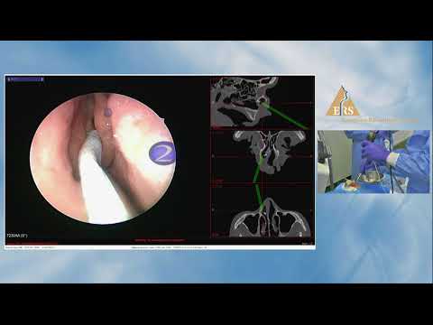 ERS London 2018, Andreas Leunig, Frontal Sinus MasterClass (Cadaveric Dissection)