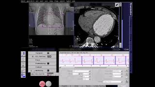 ECG Editing For CT Coronary Angiography - Heart Rate (Atrial Fibrillation)