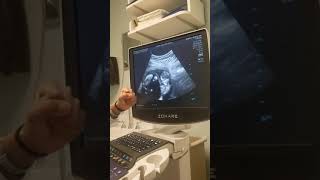 13 weeks ultrasound of twins
