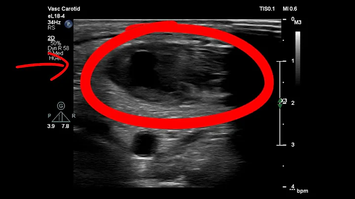 follow up after 3 weeks treatment- LMWH- progression Internal jugular vein #thrombosis and #abscess