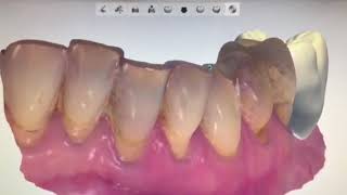 Cerec Scan Body On 3Shape Dental Studio