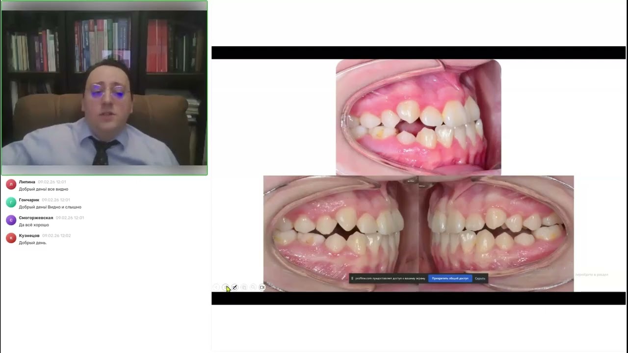 Sagittal First в действии: практика применения аппарата Motion 3D для лечения сагиттальных аномалий