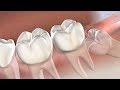 Wisdom Teeth Removal: What You Want To Know in Las Vegas, NV