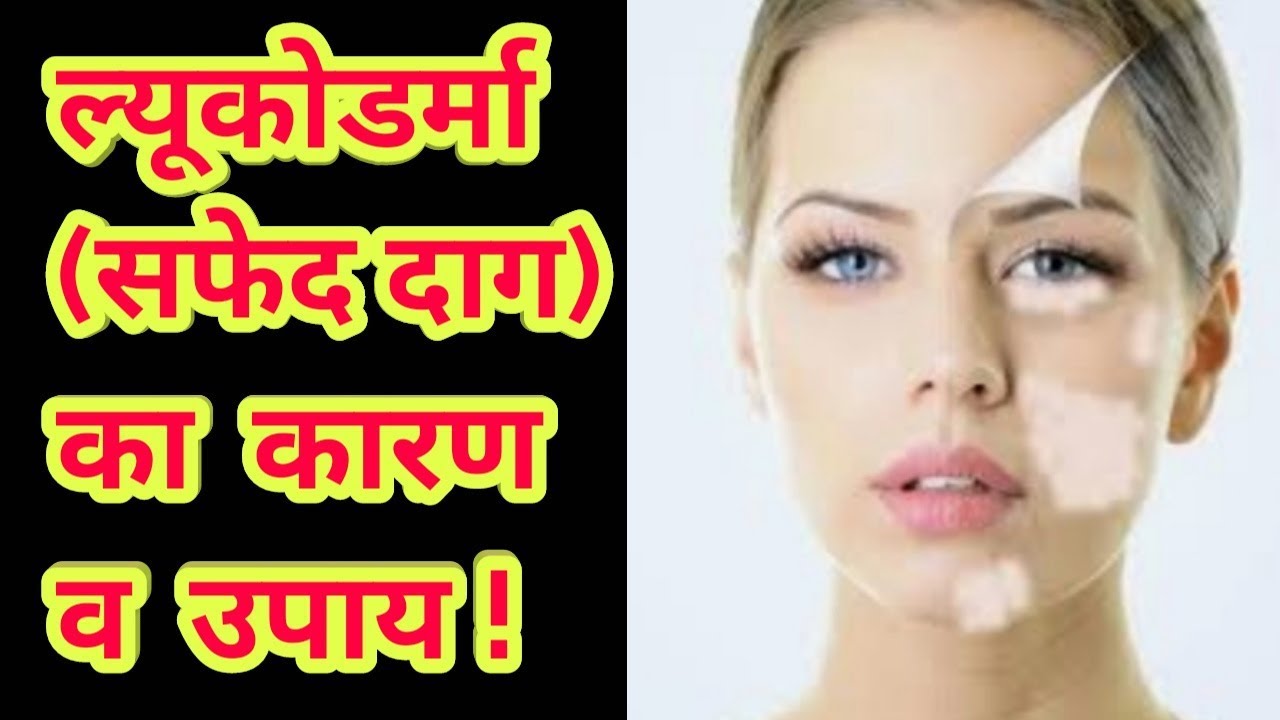 vitiligo treatment in india ल्युकोडर्मा (सफेद दाग) का कारण व उपाय ! Home Remedies of Leukoderma | By Nature Guru