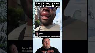 Man Got Stung By A Bee And His Lip Tripled In Size