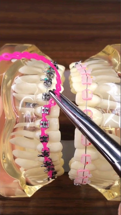 ortho love Colourfull E-chain | Braces Before and after | your dentist #shorts #shortvideo #short