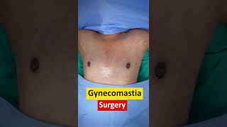 Gynecomastia result | Gynecomastia surgery cost | Gynecomastia Surgery | Gynecomastia Video