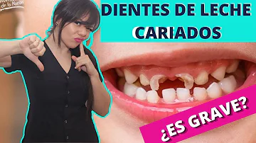 ¿Qué aspecto tienen los dientes de leche podridos?