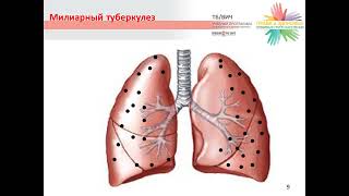 Учебный фильм Клинические проявления туберкулеза