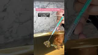 Watch Me Dissolve Filler dermalfiller dissolvingfiller dermalfillerdissolving doctor billericay