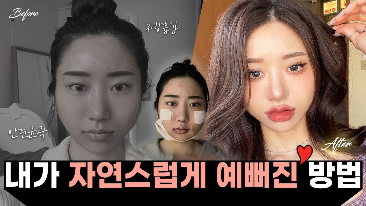 [Вэри Гүүд Гоо сайхны мэс заслын эмнэлэг] Чи нүүрний хэлбэрээ л засуулбал төгс болно шүү 🙏🏻 | Нүүрний хэлбэр засах мэс заслын бодит сэтгэгдэл