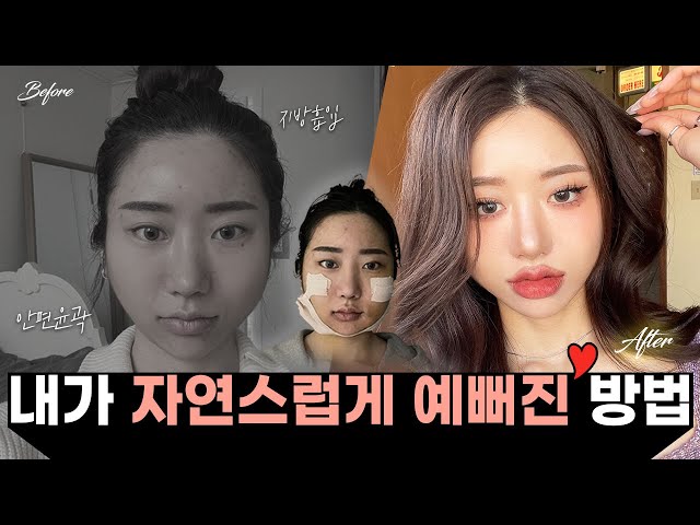 너는 윤곽만 하면 완벽할 듯 🙏🏻 | 윤곽 수술 Real 후기